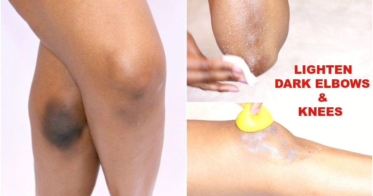 5 ways to naturally get rid of dark elbows and knees