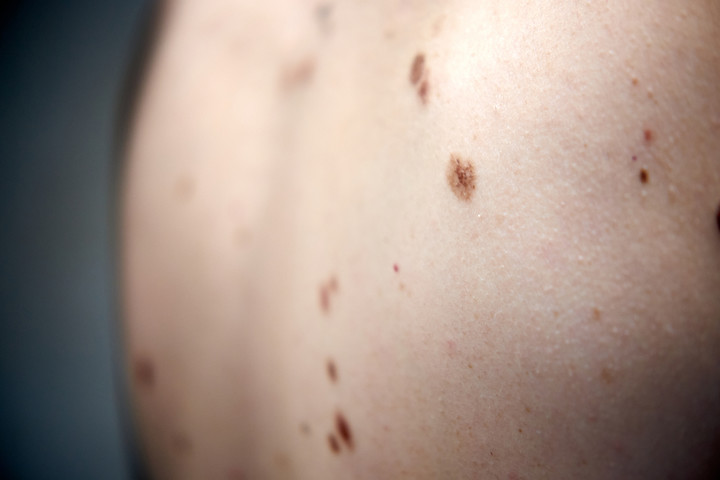 Uszkodzenia skóry i ich długofalowe skutki, czyli nowotwory