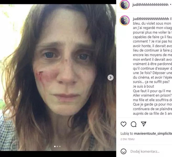 Francuska aktorka ujawniła fotografie przedstawiające konsekwencje przemocy ze strony byłego partnera / Instagram @judithhhhhhhhhhhhhh