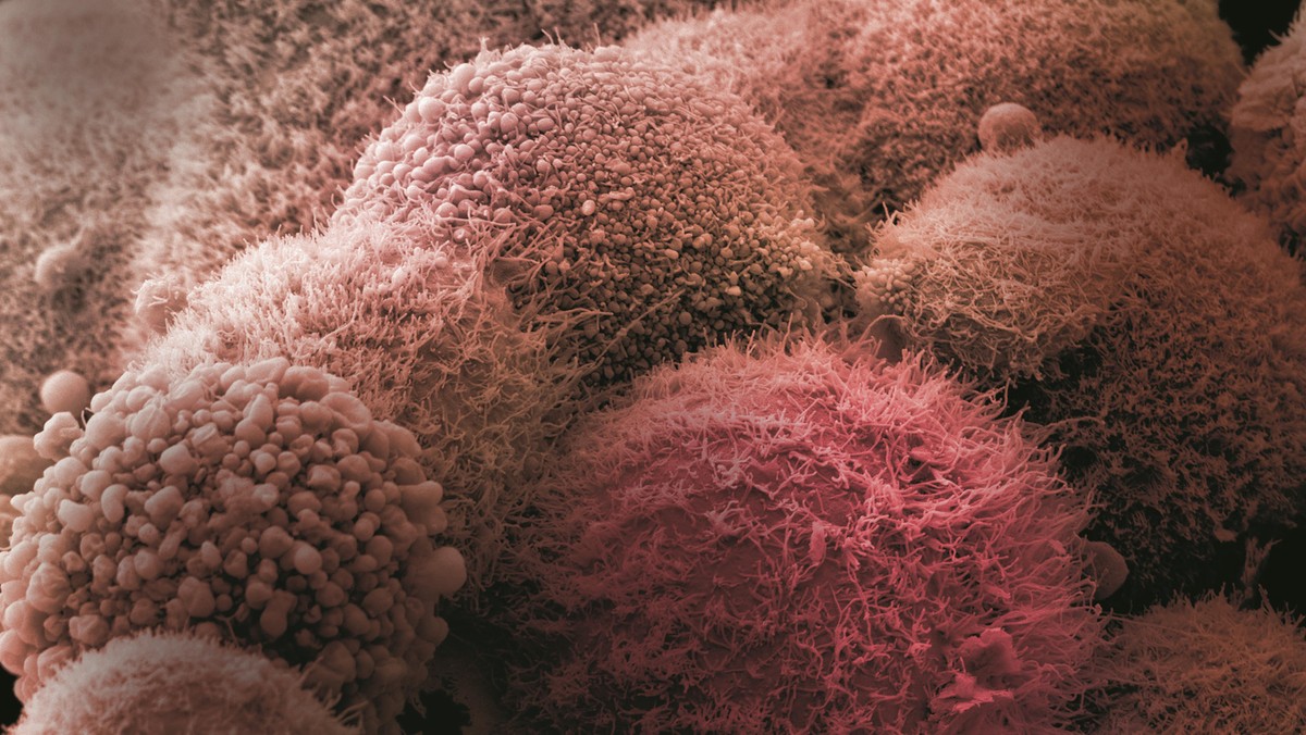 Cluster of pancreatic cancer cells