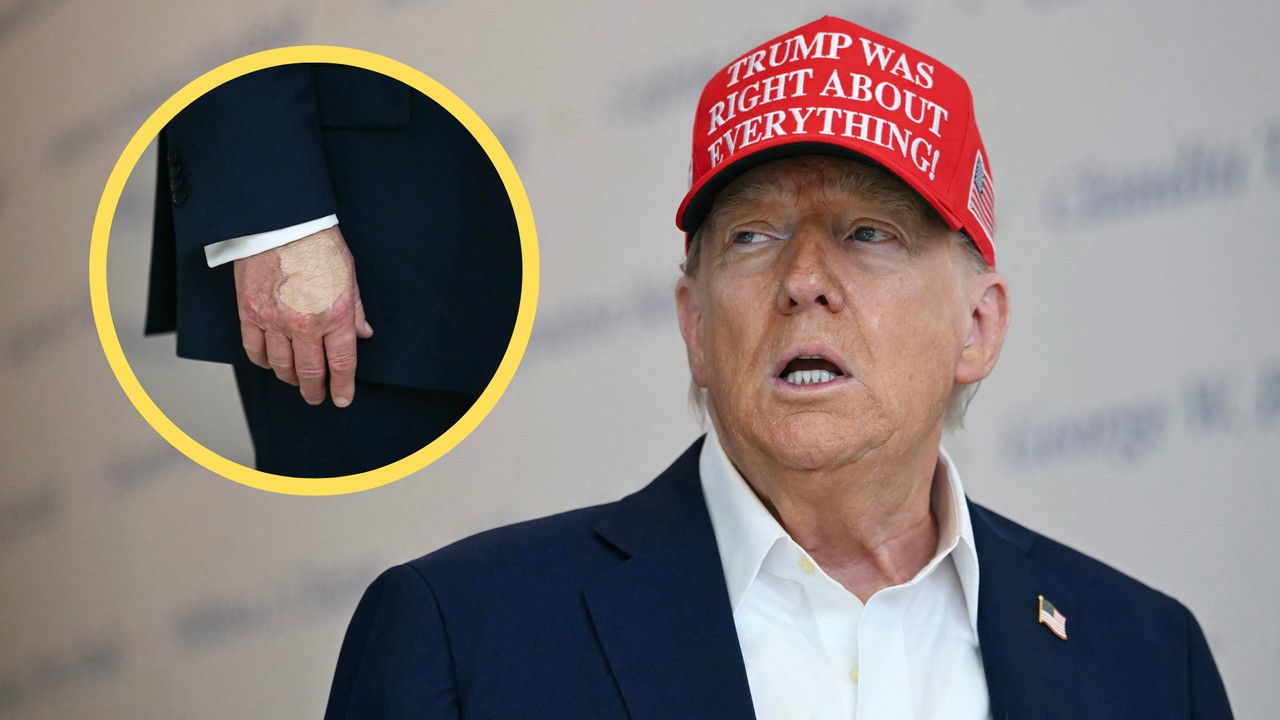 Dziwny wygląd dłoni Donalda Trumpa przykuł uwagę dziennikarzy. Biały Dom tłumaczy