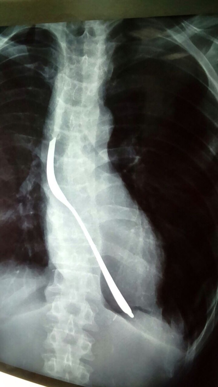 Čovek progutao viljušku