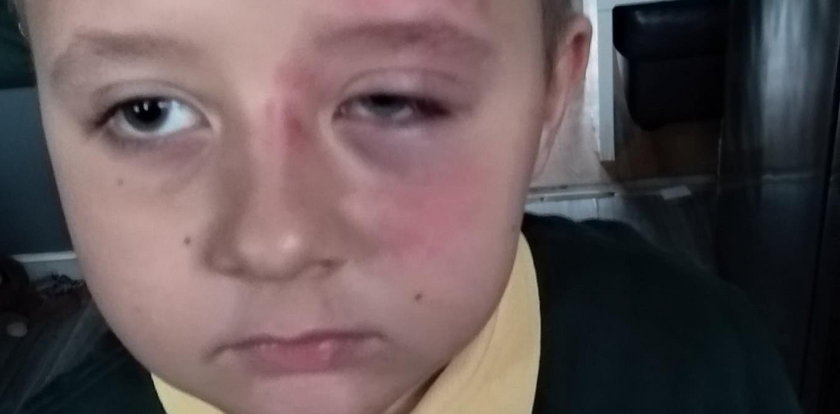 7-letni Gabryś brutalnie pobity w szkole. Rzecznik Praw Dziecka zapowiada interwencję
