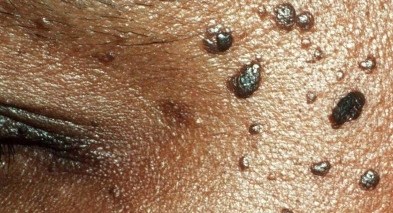  Skin tags: Safe methods of removal, prevention