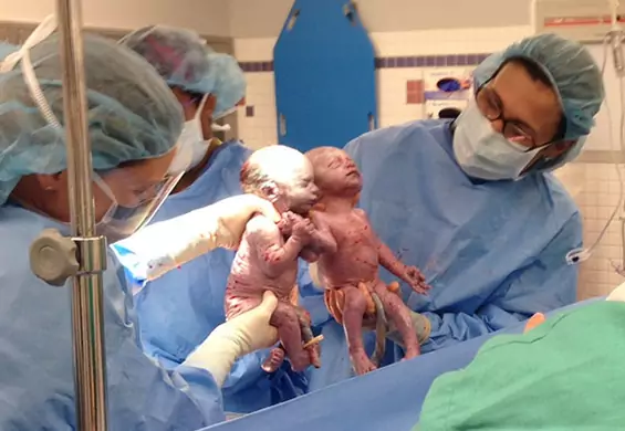 Te bliźniaczki "mono-mono" urodziły się trzymając się za ręce, 2 lata poźniej wciąż są nierozłączne
