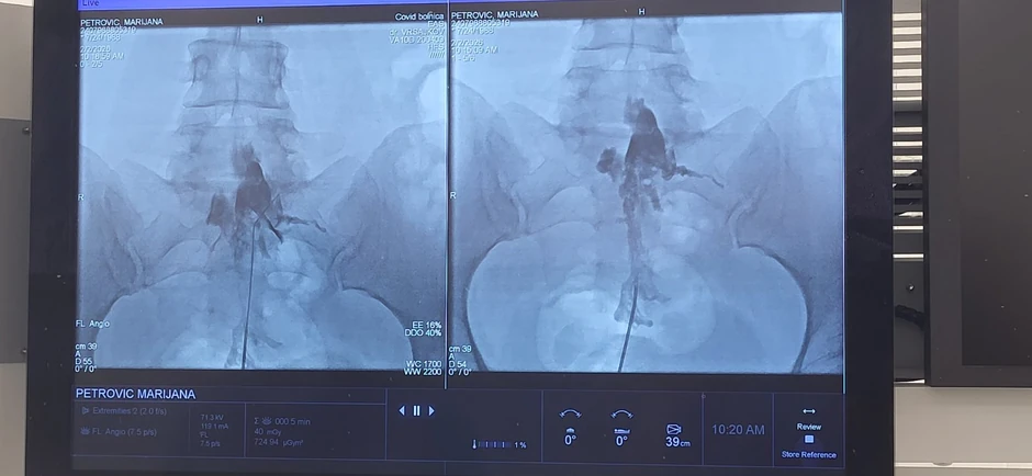 Epiduralna adhezioliza