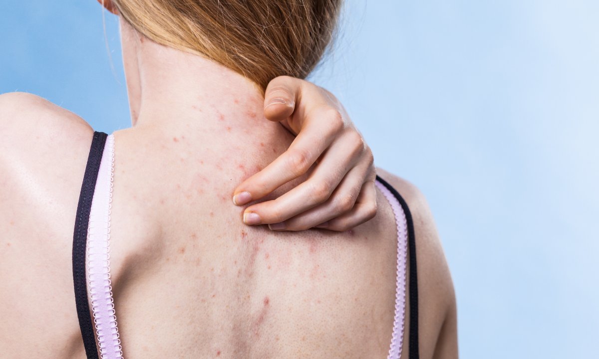 Koniec z krostkami na plecach i pośladkach! To serum świetnie nawilża i likwiduje niedoskonałości