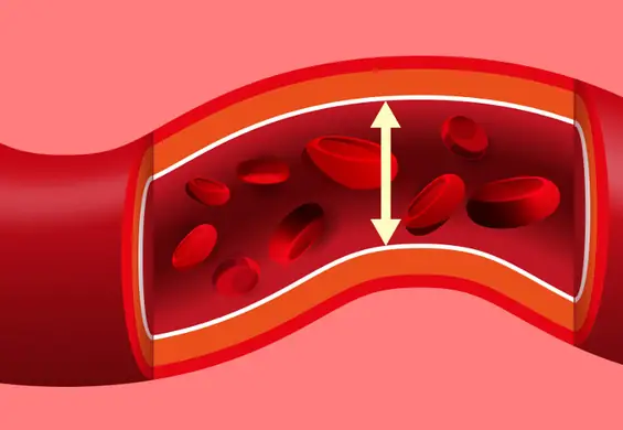 4 ciche objawy miażdżycy, których nie powinno się lekceważyć