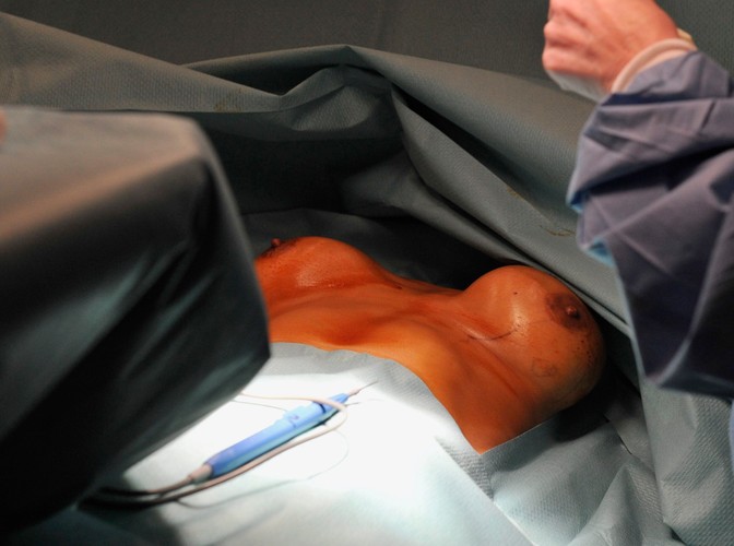 Tylko we Francji wśród kobiet z silikonowymi implantami piersi PIP stwierdzono 20 przypadków zachorowań na raka, w tym 16 przypadków guzów złośliwych. Kobiety z sztucznym biustem masowo zgłaszają się na operację usunięcia implantów.