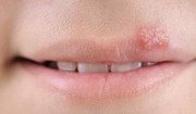 Opryszczka na ustach – skąd się bierze? Jak ją leczyć?