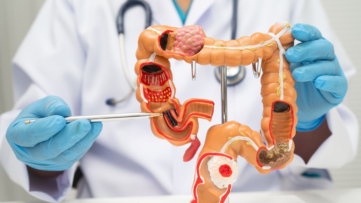 Rak debelog creva sve češće se beleži kod mlađih od 50 godina