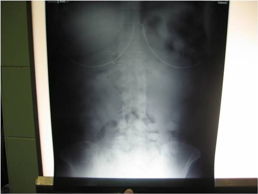 Rentgenski snimak uhapšene Bolivijke