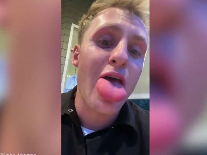 Student Koub Frimen pokazao kako jede i govori nakon što ga je pčela ubola u jezik