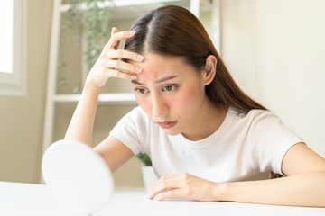 kiütés, bőrpír, autoimmun betegség, gyulladás, lupus, lupusz