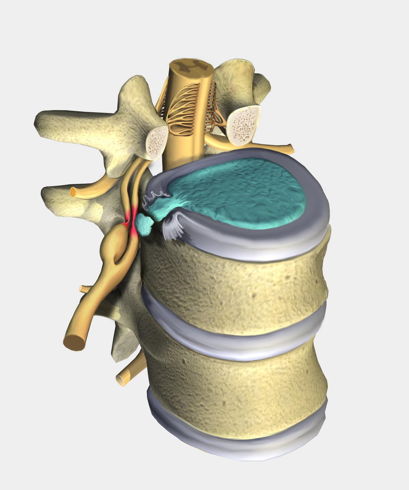 Krążki międzykręgowe z czasem zużywają się. Aby przywrócić ich funkcje i złagodzić ból wstrzykuje się specjalny żel 