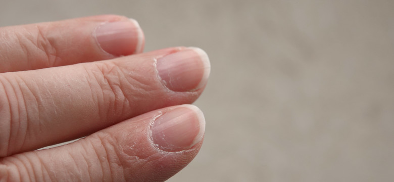 Pękające skórki przy paznokciach. Jak uniknąć ich zadzierania się?
