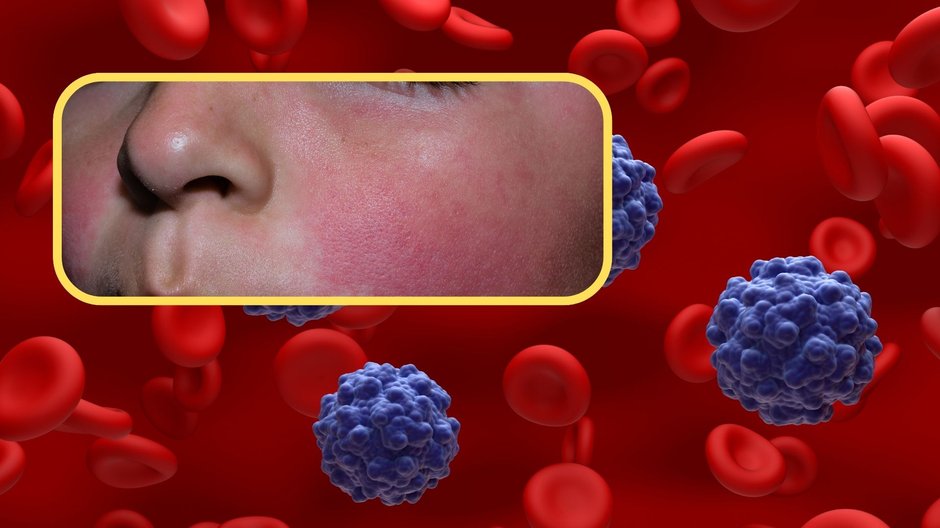 "Piąta choroba" u dzieci. Wiosną to szczególna zmora. Pediatra tych