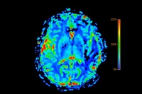 Naukowcy odkryli mechanizm rozprzestrzeniania się Alzheimera w mózgu