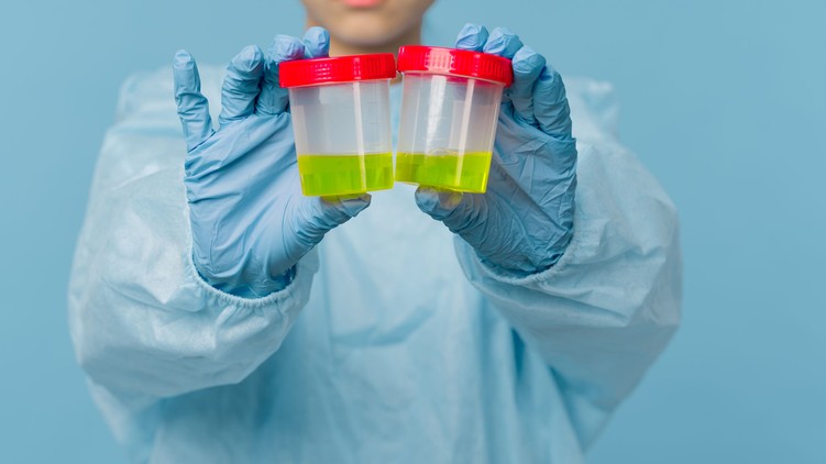 vizeletszín melyik vitamin miatt változik meg