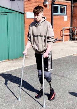 Levi csodával határos módon felépült, dacolva minden esélynel, azóta is kellett tanulnia lábak nélkül.