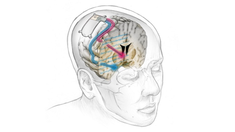„Rozrusznik mózgu” pomógł pacjentce wyjść z ciężkiej depresji