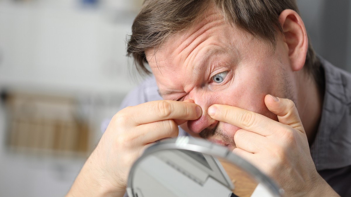 Prisilno istiskivanje mitesera može da iziritira područje na kome se nalazi