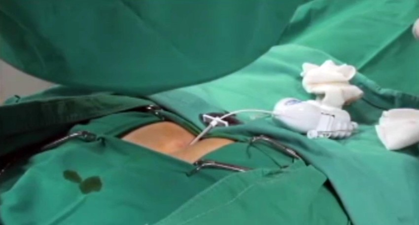 Operacija kičme hologram