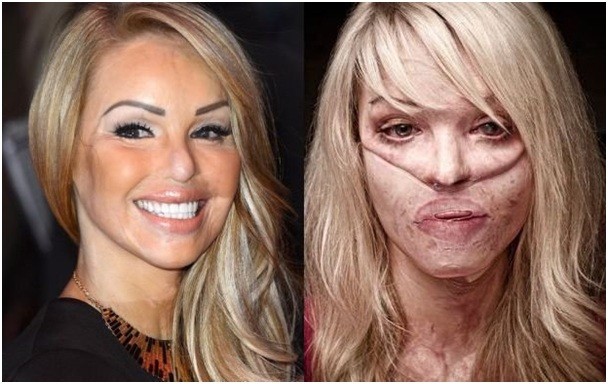 Katie Piper - przed i po wypadku