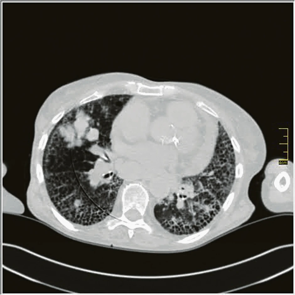 Pik faza (10. do 13. dan) - javljaju se konsolidacije pluća, to znači da veliki delovi pluća izgledaju kao velike bele površine, a označavaju delove pluća koji su masa koja je u celini zahvaćena zapaljenskim procesom