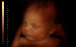 Jeszcze się nie urodził, a już był operowany. Przez 'dziurkę od klucza'