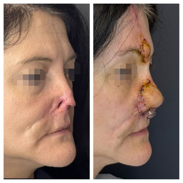 Brak nosa to nie tylko utrata funkcji fizjologicznych, jak filtrowanie czy ogrzewanie powietrza, lecz przede wszystkim potężna trauma psychologiczna