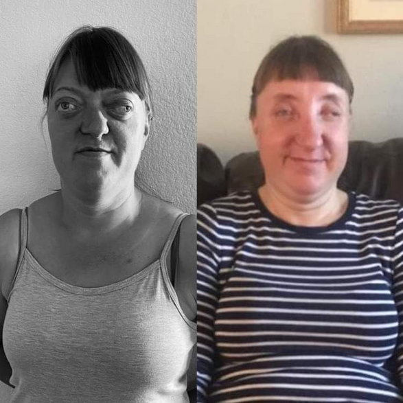 Ewa przed i po operacji