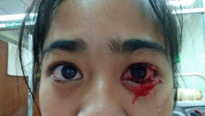 Brutális fotók: vért könnyezik a fiatal lány - az orvosok nem tudják, mitől - fotók 18+