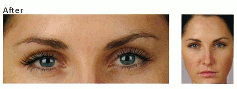 Vegán vagy? Ezért jobb, ha a botoxot is elkerülöd