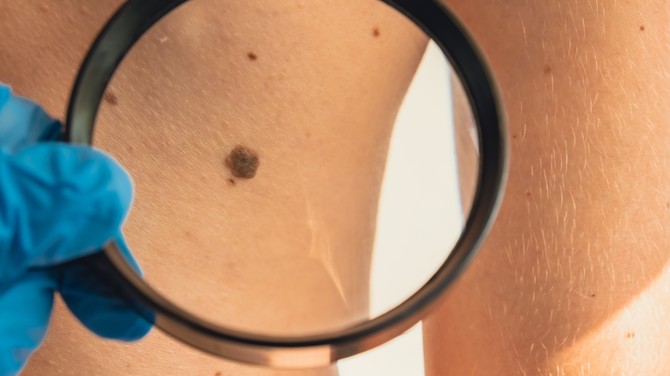Ako primetite da je mladež promenio oblik ili boju, odmah kod dermatologa