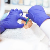 Ekkor lehet szükség bőrbiopsziára: nem csak rákgyanú esetén végzik