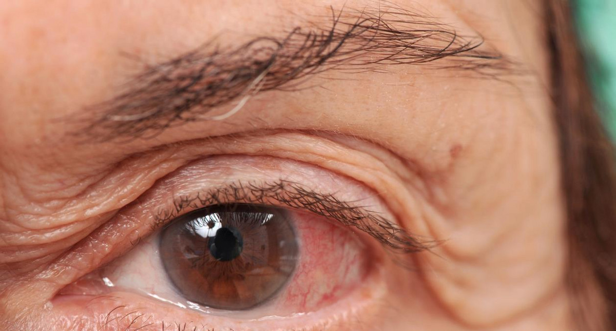 Sulfacetamidum - kiedy i jak stosować? Jak leczyć chore oczy?