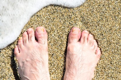 Gombás fertőzés a strandon: ebből jöhet rá, ha lábgombája van