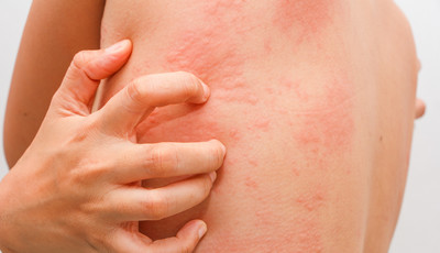 Alergia Objawy Rodzaje I Leczenie Alergii Uczulenie Na Pylki