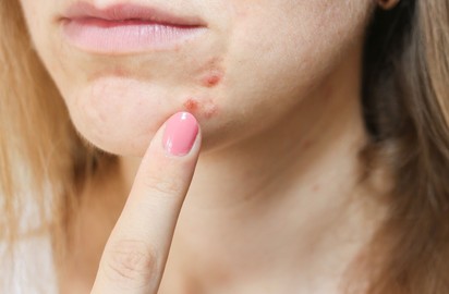 Hormonzavar is okozhatja azt, ha így néz ki az arca