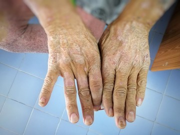 Kemény, érdes bőr: nem szimpla bőrbetegség, ha scleroderma okozza