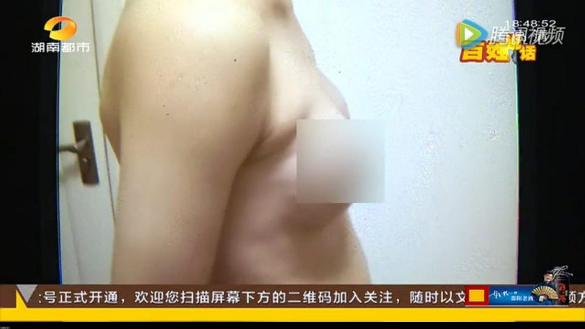 Ho z Zhuzhou zainwestował w implanty piersi