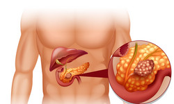 Czy raka trzustki można uniknąć? To jeden z najbardziej podstępnych i trudnych w leczeniu nowotworów