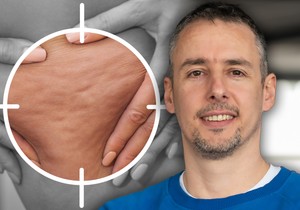 Celulit je kompleksan problem koji zahteva sistemski pristup