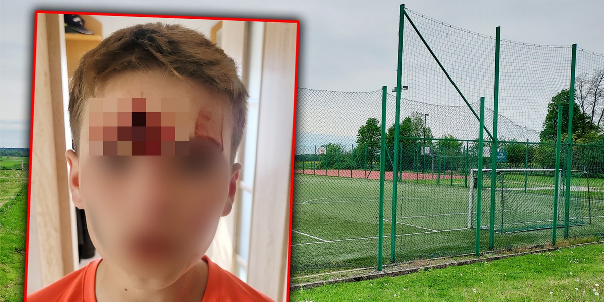 Zawistny nastolatek wygryzł piłkarzowi dziurę w czole.