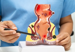 Analni otok je znak upale u tkivima 