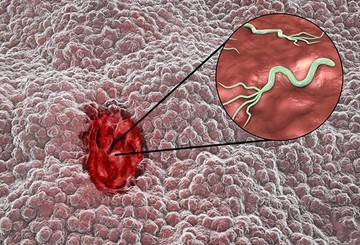 A gyomorfekélyt gyakran a Helicobacter pylori fertőzés okozza