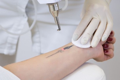 Tetováltatás véralvadásgátló mellett - az orvos elárulja, biztonságos-e