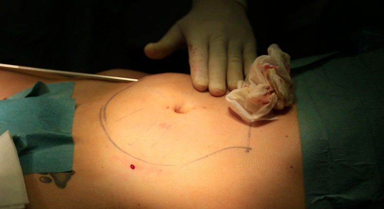 Liposuction is a cosmetic procedure that is popular with medical tourists, because it can be performed much cheaper in Mexico compared to the US.REUTERS/Laszlo Balogh