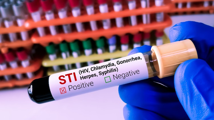 nemi betegség STI szifilisz HIV chlamydia